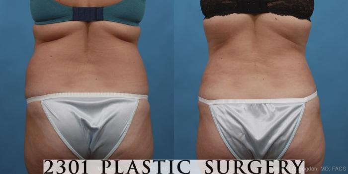 Before & After Tummy Tuck Case 433 View #5 View in Fort Worth, Plano, & Frisco, Texas