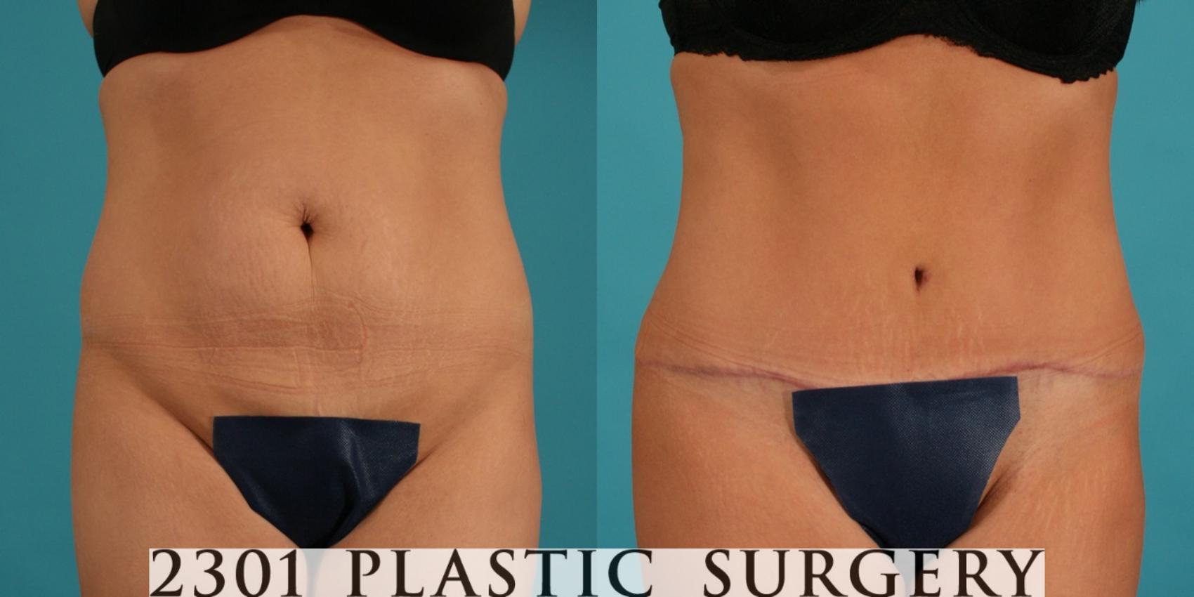 Case 354  Tummy Tuck Revision Before & After Photos