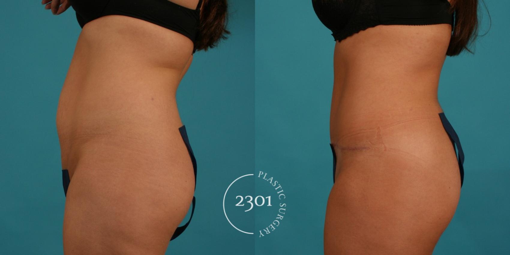 Before & After Tummy Tuck Case 44 View #2 View in Fort Worth, Plano, & Frisco, Texas