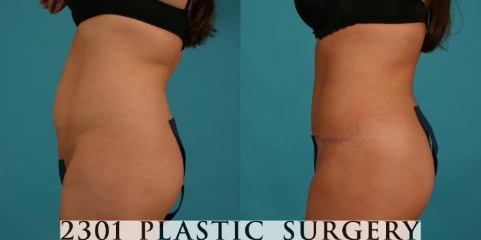 Before & After Tummy Tuck Case 44 View #2 View in Fort Worth, Plano, & Frisco, Texas