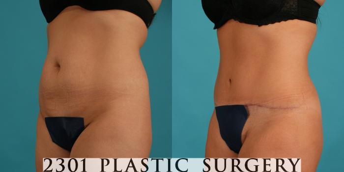 Before & After Tummy Tuck Case 44 View #3 View in Fort Worth, Plano, & Frisco, Texas