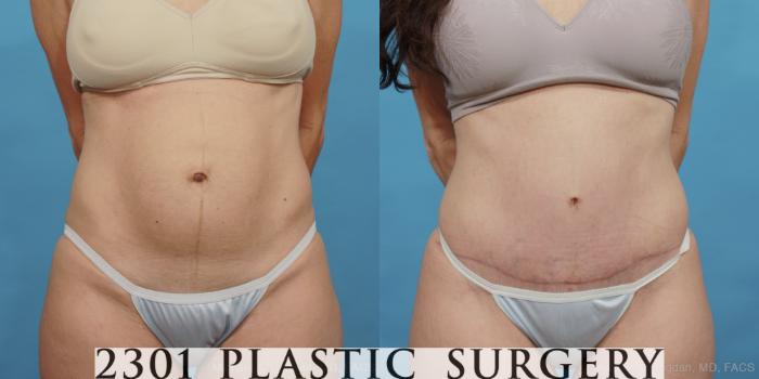Before & After Tummy Tuck Case 446 View #1 View in Fort Worth, Plano, & Frisco, Texas