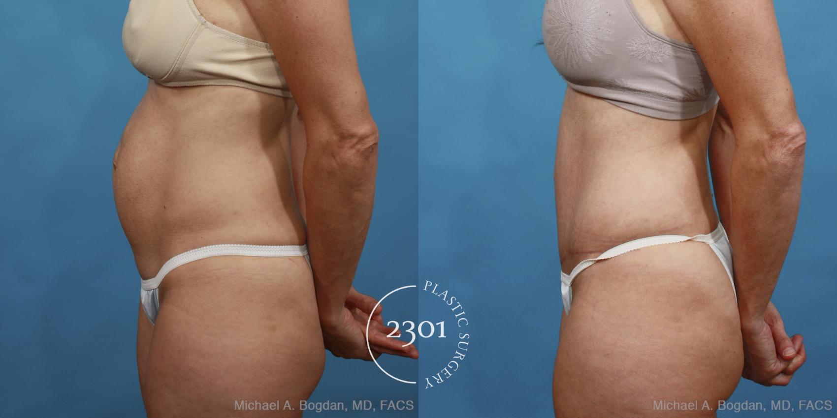 Before & After Tummy Tuck Case 446 View #2 View in Fort Worth, Plano, & Frisco, Texas