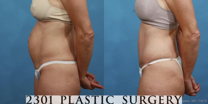 Before & After Tummy Tuck Case 446 View #2 View in Fort Worth, Plano, & Frisco, Texas