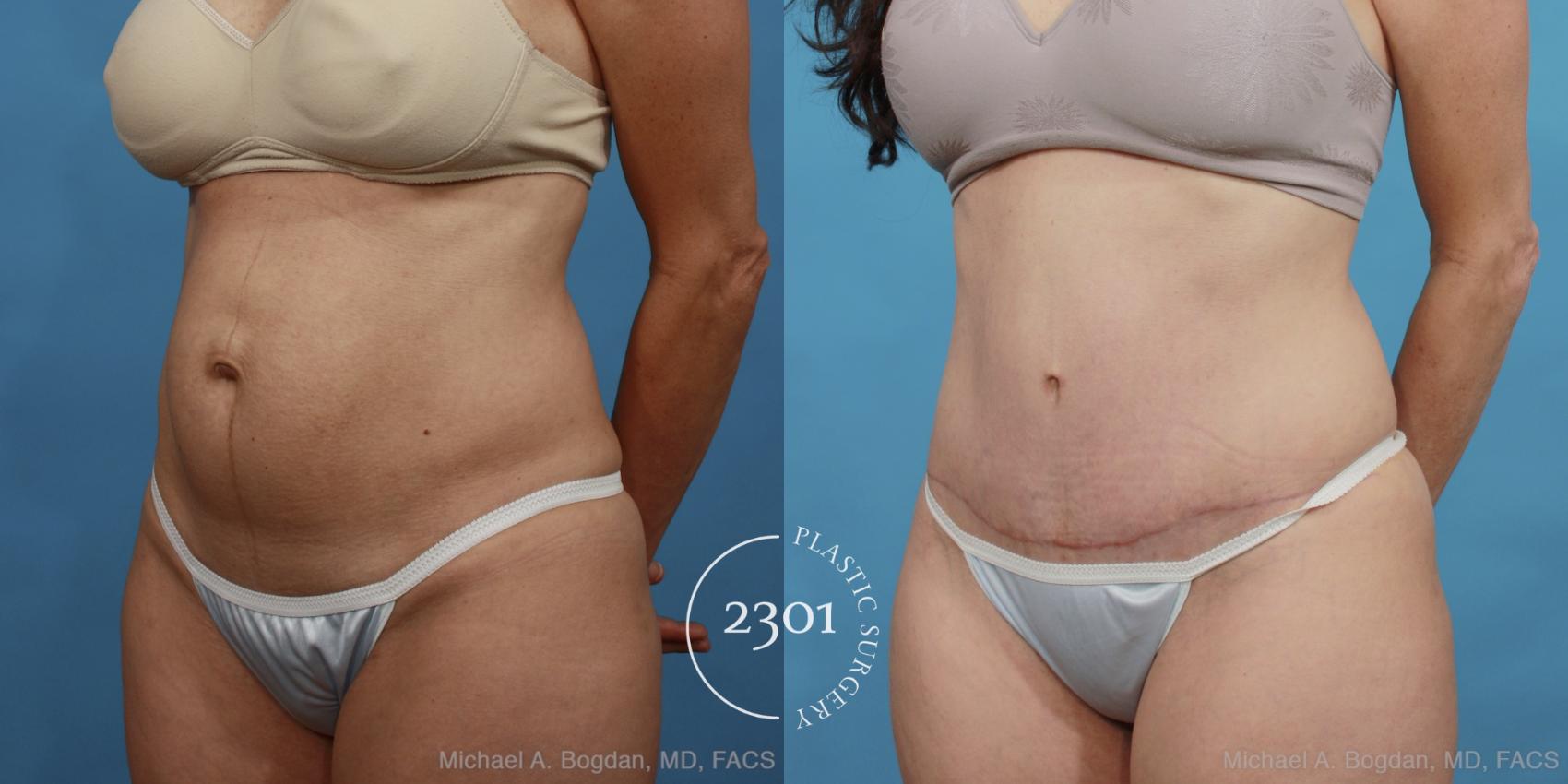 Before & After Tummy Tuck Case 446 View #3 View in Fort Worth, Plano, & Frisco, Texas