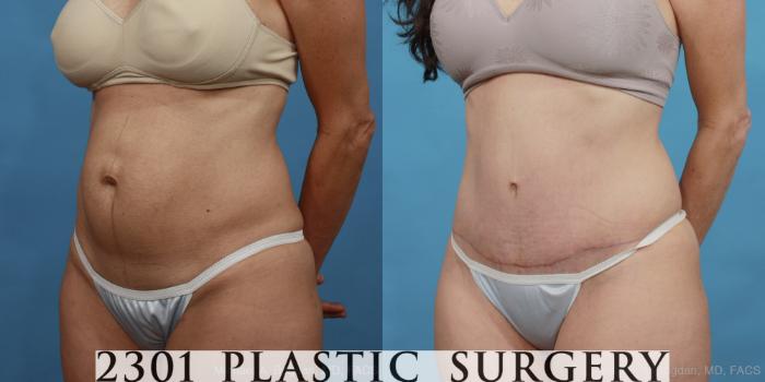 Before & After Tummy Tuck Case 446 View #3 View in Fort Worth, Plano, & Frisco, Texas