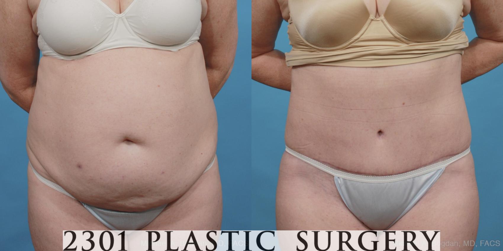 Before & After Tummy Tuck Case 447 View #1 View in Fort Worth & Frisco, Texas