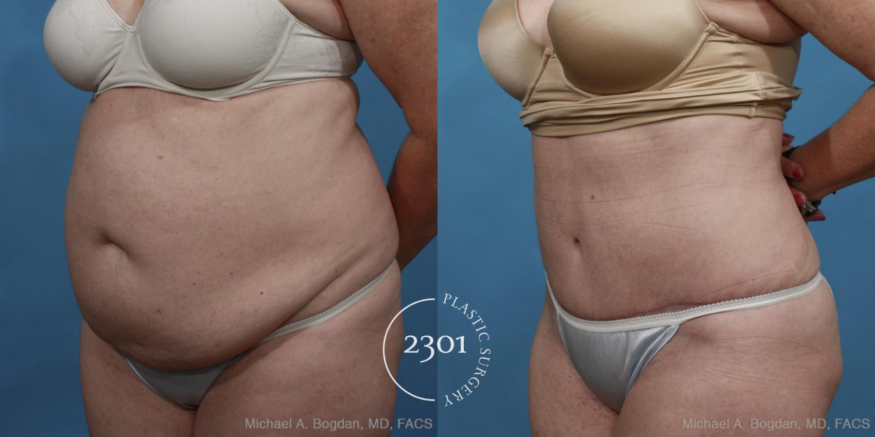 Before & After Tummy Tuck Case 447 View #2 View in Fort Worth, Plano, & Frisco, Texas