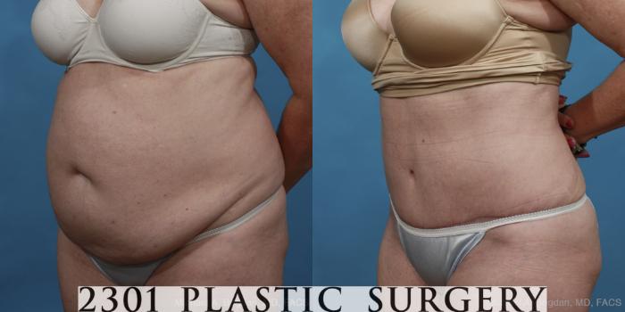 Before & After Tummy Tuck Case 447 View #2 View in Fort Worth, Plano, & Frisco, Texas