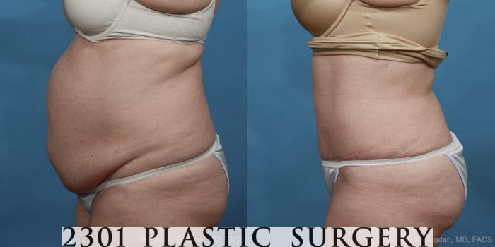 Before & After Tummy Tuck Case 447 View #3 View in Fort Worth, Plano, & Frisco, Texas