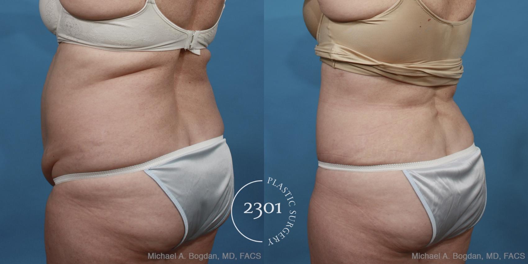 Before & After Tummy Tuck Case 447 View #4 View in Fort Worth, Plano, & Frisco, Texas