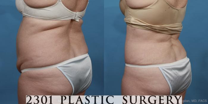Before & After Tummy Tuck Case 447 View #4 View in Fort Worth, Plano, & Frisco, Texas
