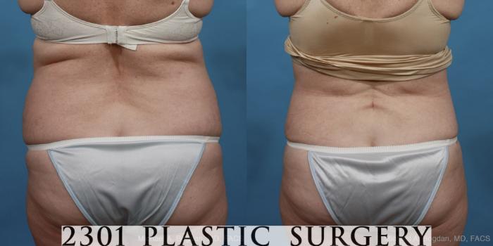 Before & After Tummy Tuck Case 447 View #5 View in Fort Worth, Plano, & Frisco, Texas