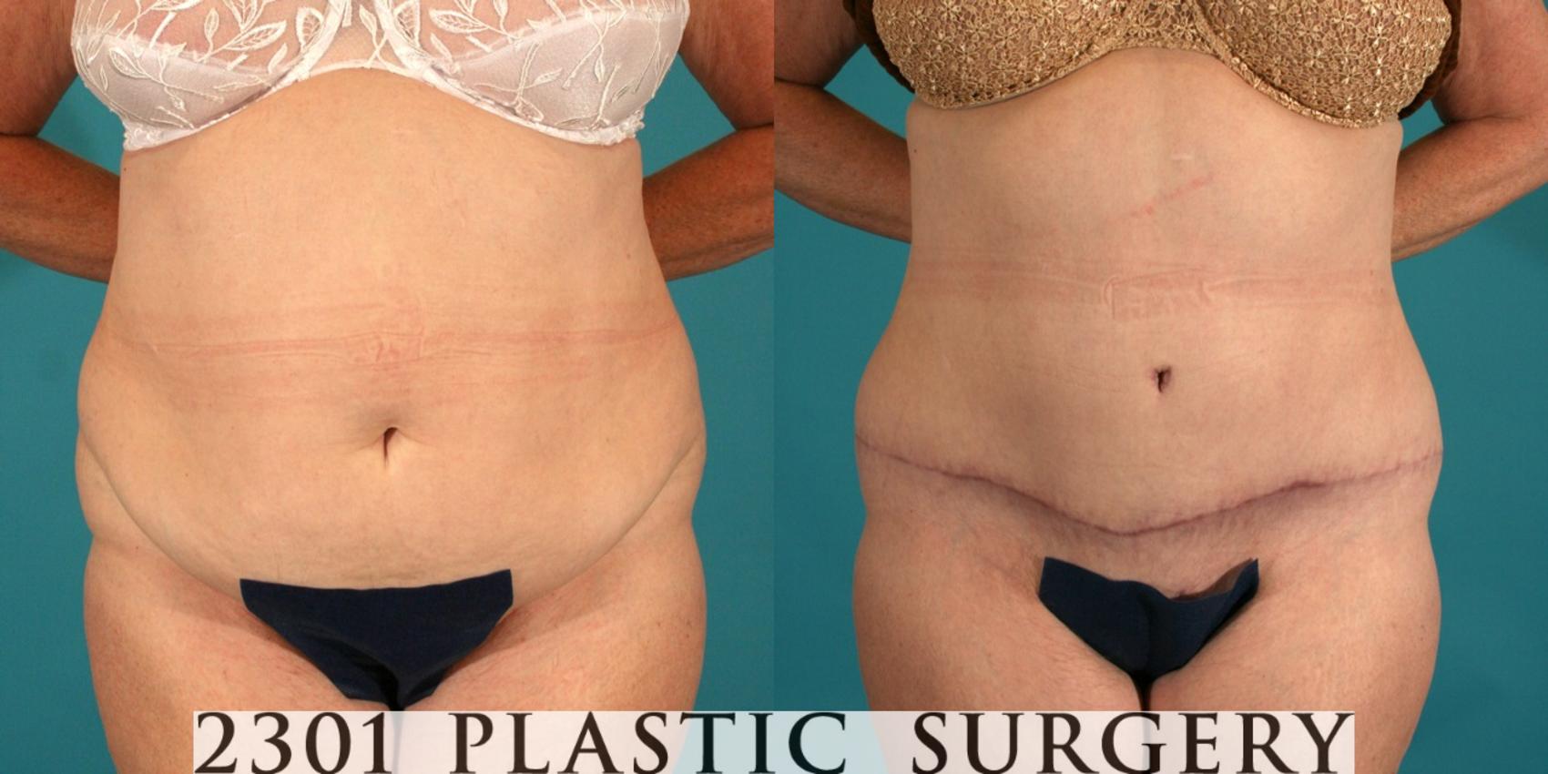 Before & After Tummy Tuck Case 45 View #1 View in Fort Worth, Plano, & Frisco, Texas