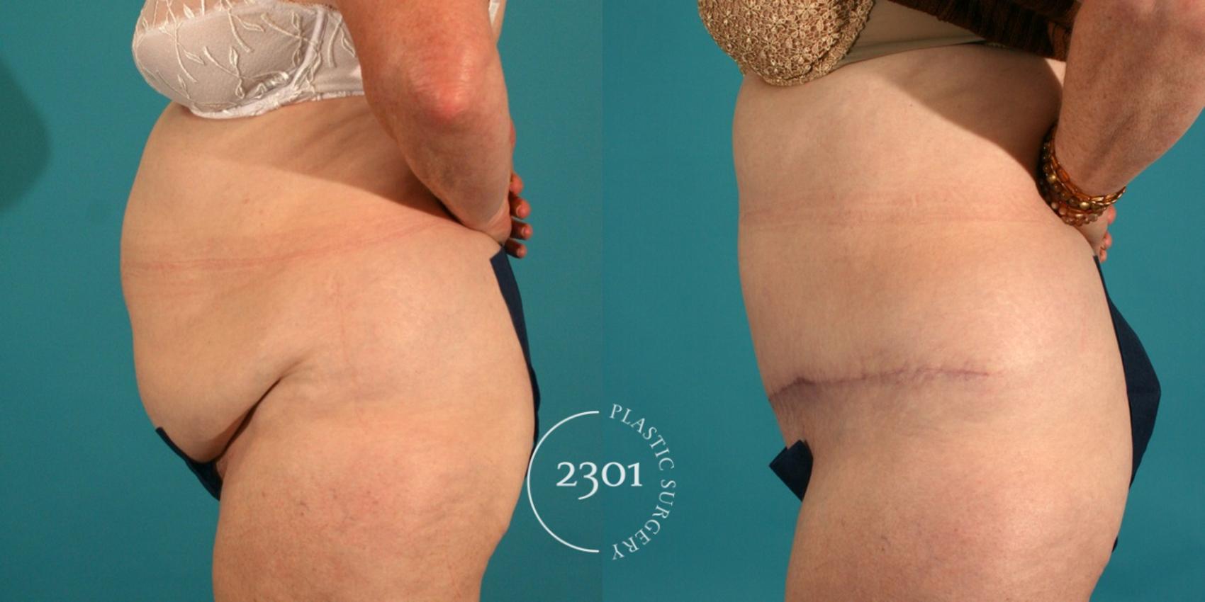 Before & After Tummy Tuck Case 45 View #2 View in Fort Worth, Plano, & Frisco, Texas