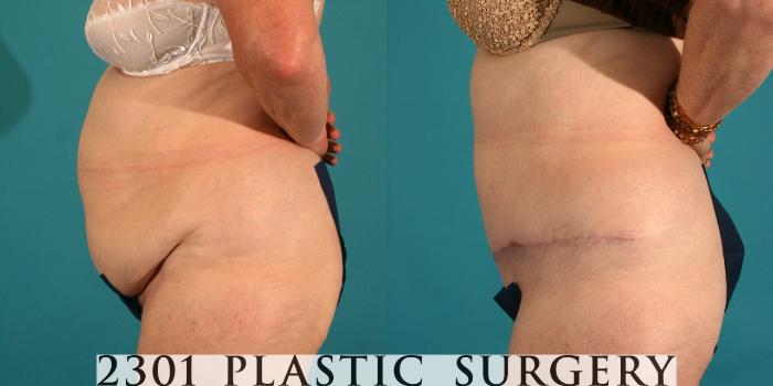 Before & After Tummy Tuck Case 45 View #2 View in Fort Worth, Plano, & Frisco, Texas