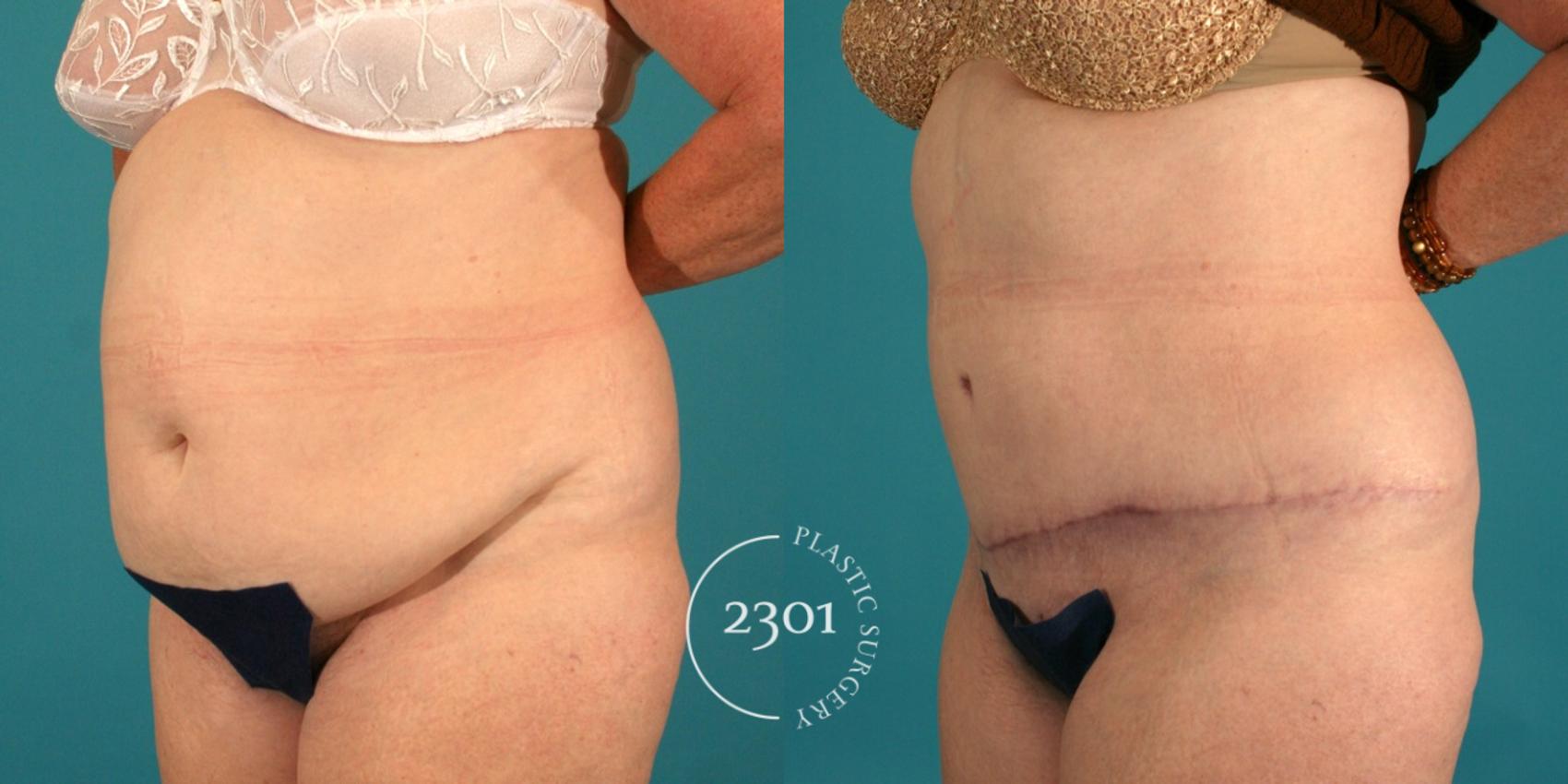 Before & After Tummy Tuck Case 45 View #3 View in Fort Worth, Plano, & Frisco, Texas
