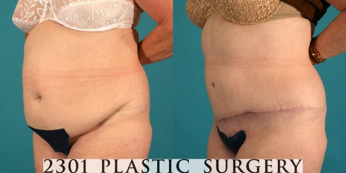 Before & After Tummy Tuck Case 45 View #3 View in Fort Worth, Plano, & Frisco, Texas