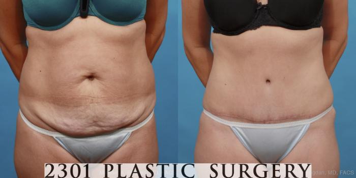 Before & After Tummy Tuck Case 451 View #1 View in Fort Worth, Plano, & Frisco, Texas