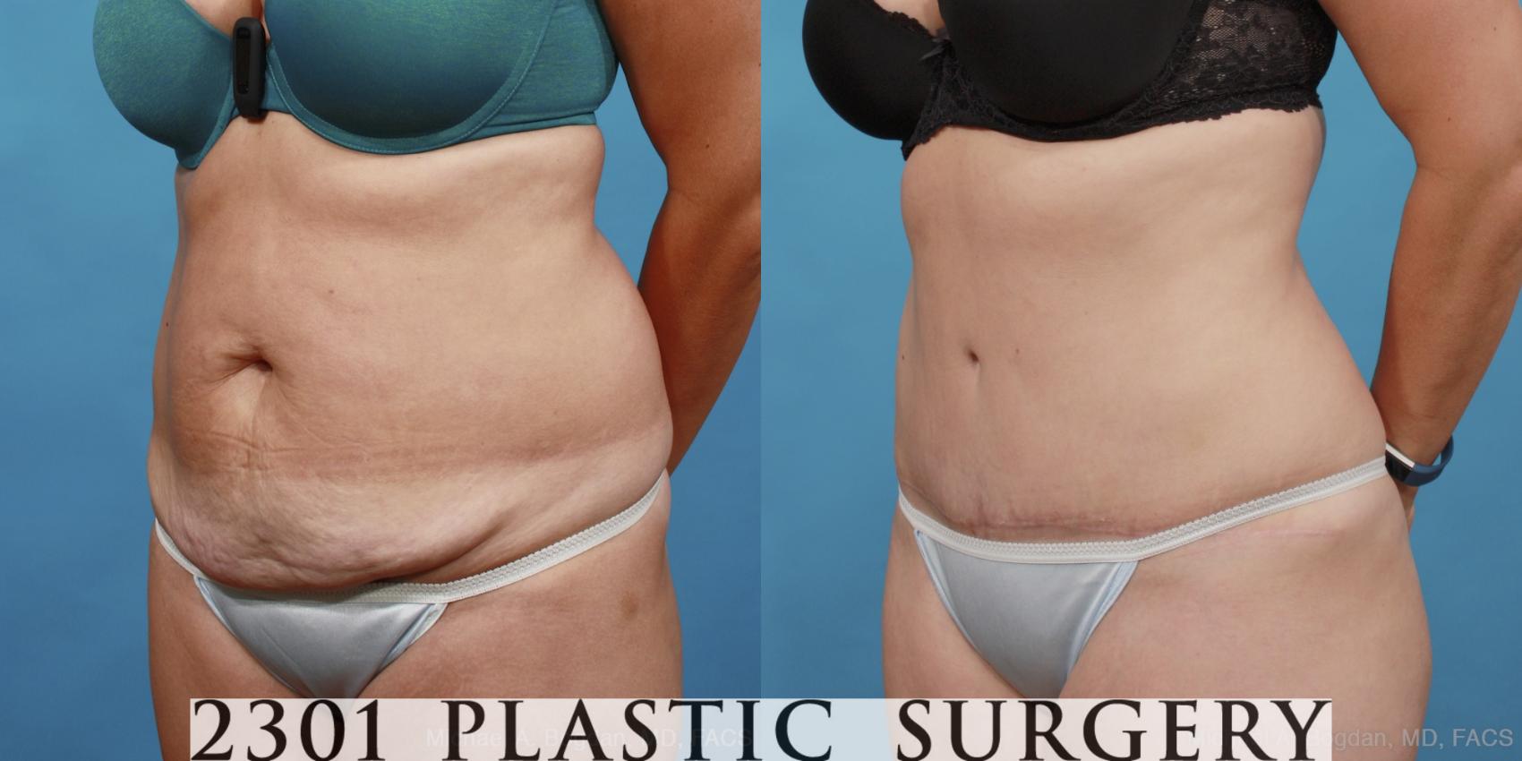 Before & After Tummy Tuck Case 451 View #2 View in Fort Worth & Frisco, Texas