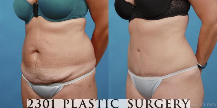 Before & After Tummy Tuck Case 451 View #2 View in Fort Worth, Plano, & Frisco, Texas