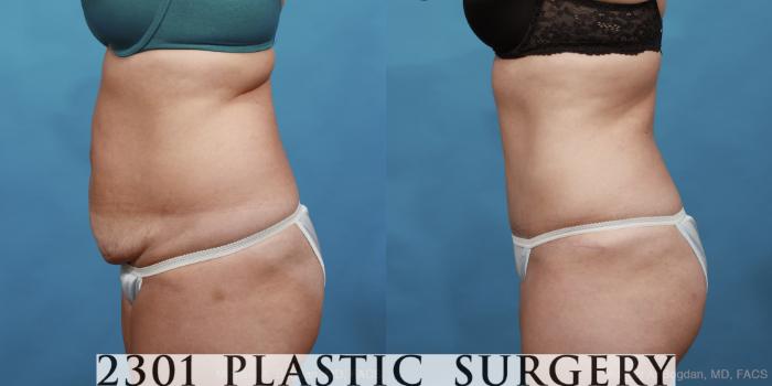 Before & After Tummy Tuck Case 451 View #3 View in Fort Worth, Plano, & Frisco, Texas