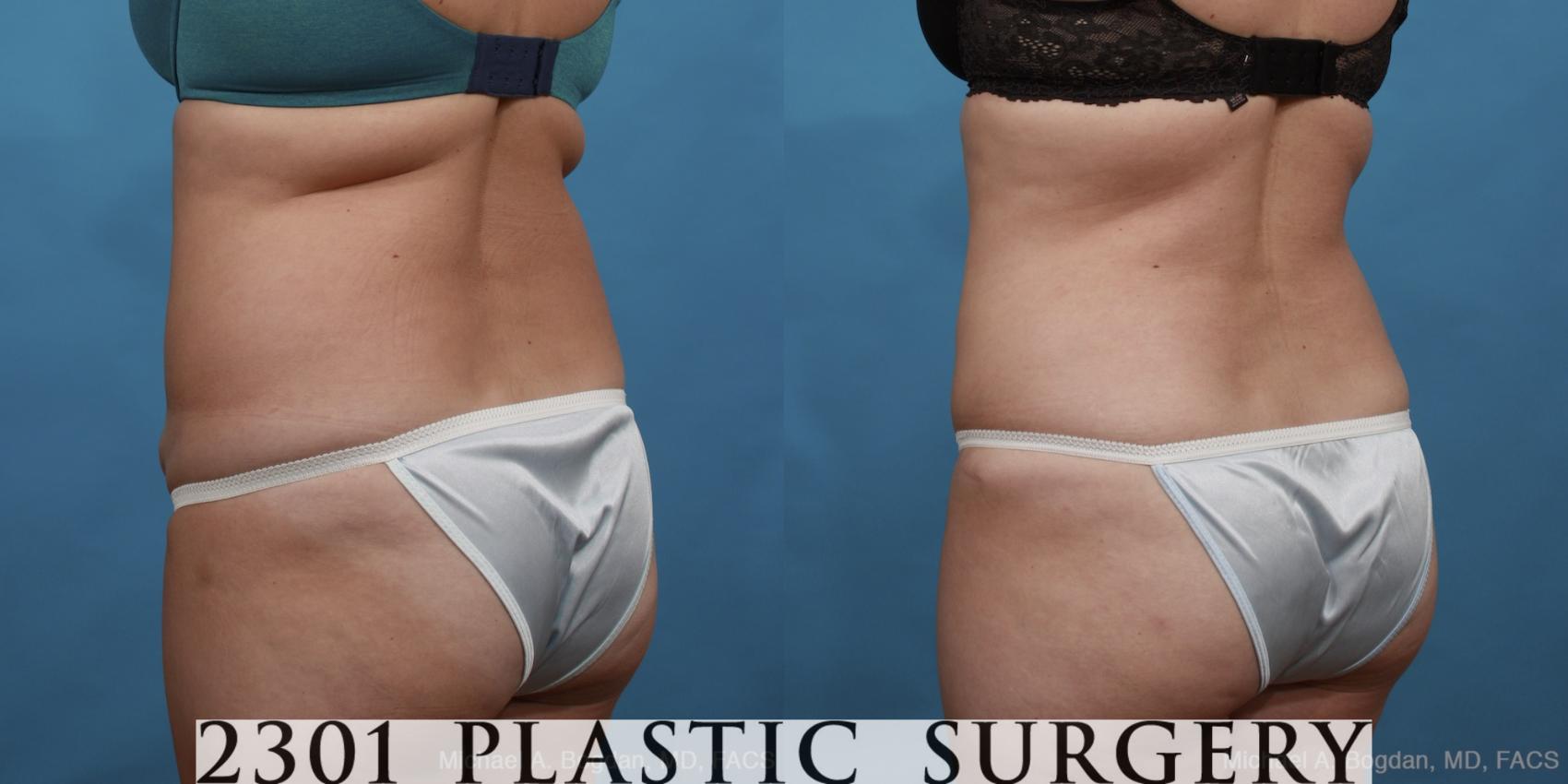 Before & After Tummy Tuck Case 451 View #4 View in Fort Worth & Frisco, Texas