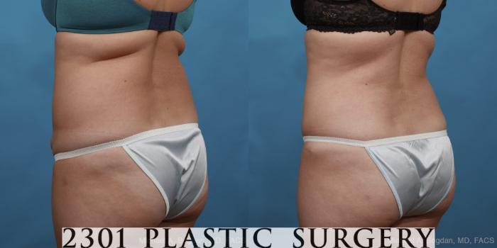 Before & After Tummy Tuck Case 451 View #4 View in Fort Worth, Plano, & Frisco, Texas