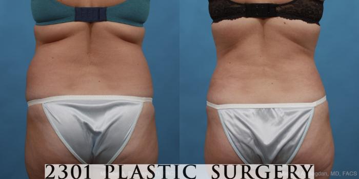 Before & After Tummy Tuck Case 451 View #5 View in Fort Worth, Plano, & Frisco, Texas
