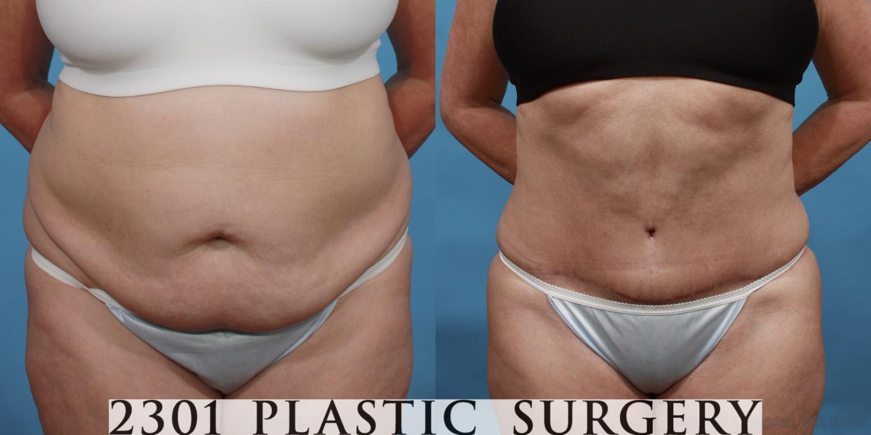 Before & After Tummy Tuck Case 492 View #1 View in Fort Worth, Plano, & Frisco, Texas