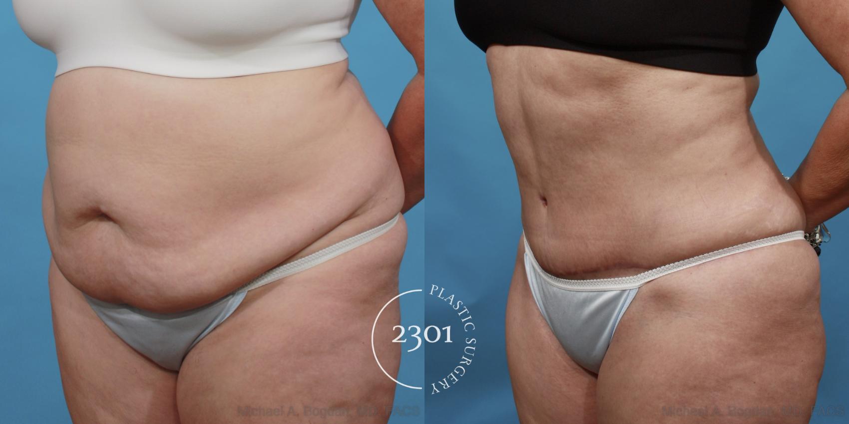 Before & After Tummy Tuck Case 492 View #2 View in Fort Worth, Plano, & Frisco, Texas
