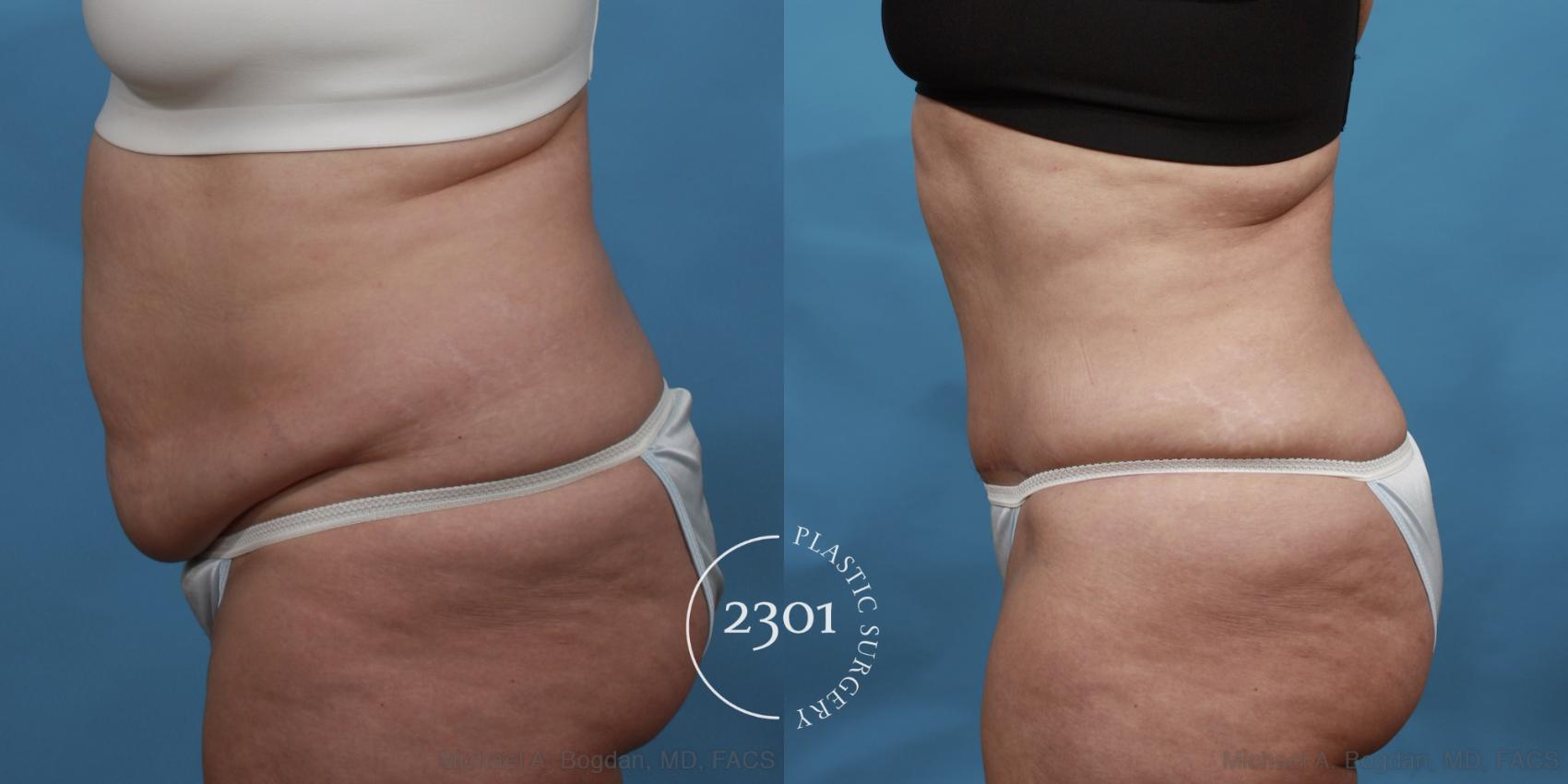 Before & After Tummy Tuck Case 492 View #3 View in Fort Worth, Plano, & Frisco, Texas