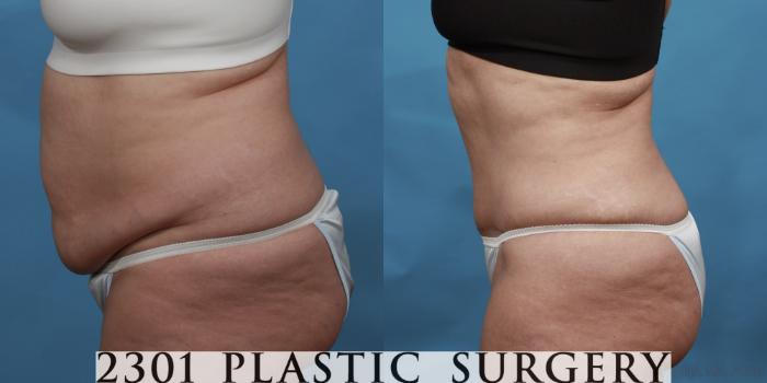 Before & After Liposuction Case 492 View #3 View in Fort Worth, Plano, & Frisco, Texas