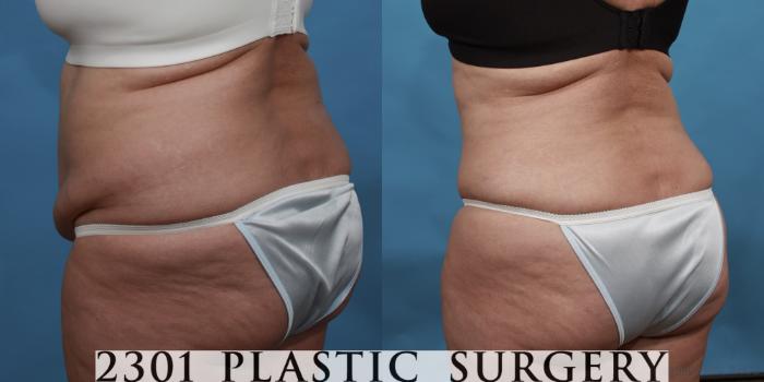 Before & After Liposuction Case 492 View #4 View in Fort Worth, Plano, & Frisco, Texas