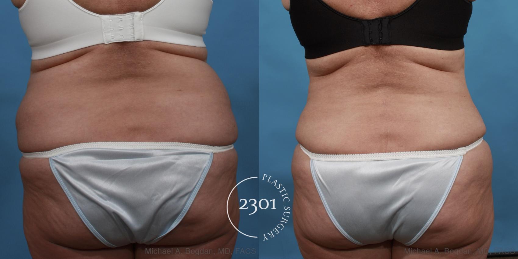 Before & After Tummy Tuck Case 492 View #5 View in Fort Worth, Plano, & Frisco, Texas