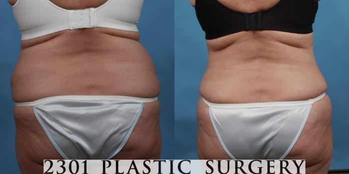 Before & After Liposuction Case 492 View #5 View in Fort Worth, Plano, & Frisco, Texas