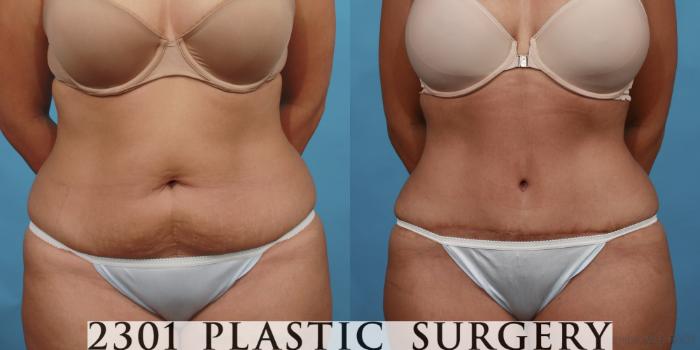 Before & After Tummy Tuck Case 500 View #1 View in Fort Worth, Plano, & Frisco, Texas
