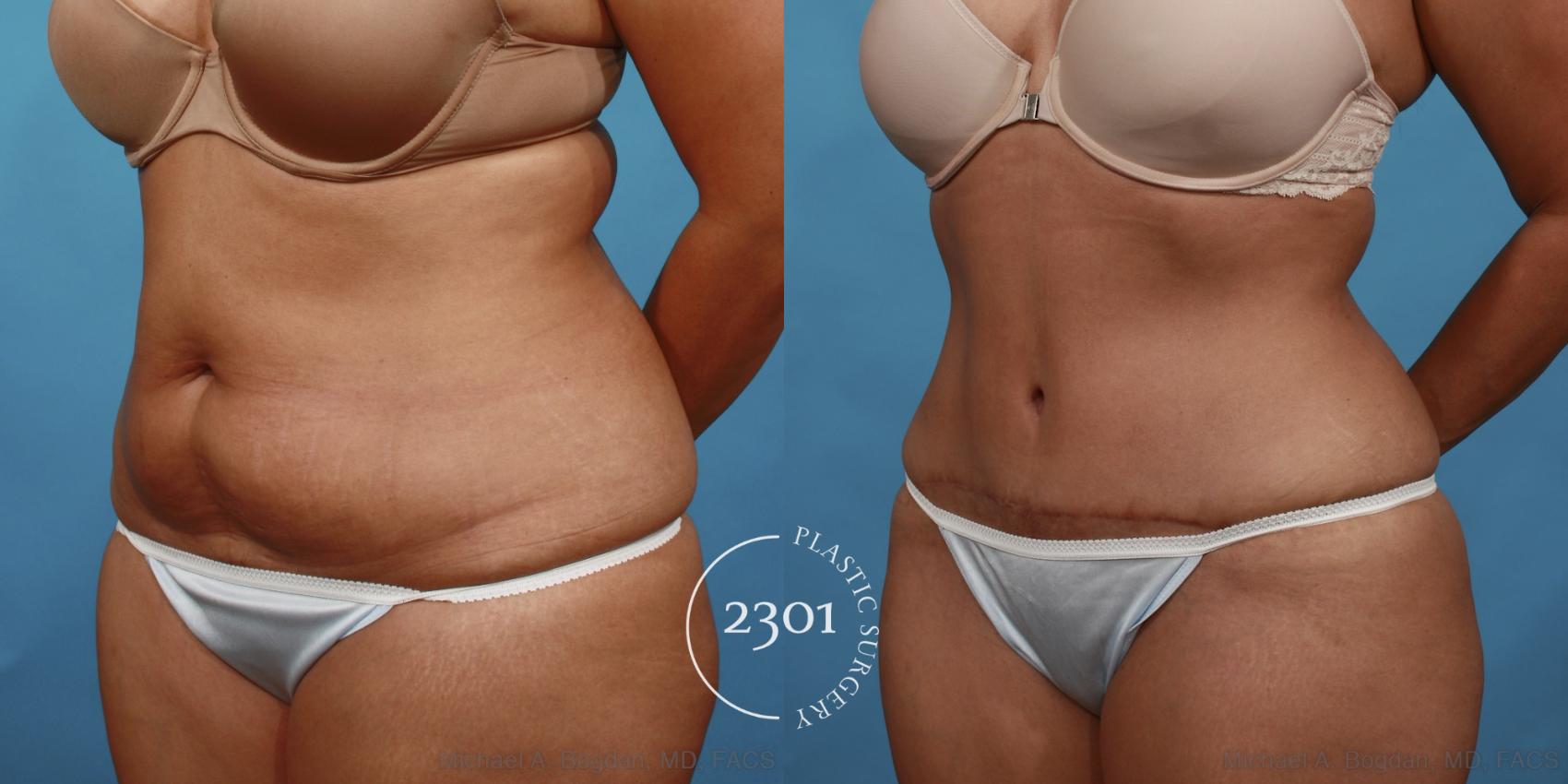 Before & After Tummy Tuck Case 500 View #2 View in Fort Worth, Plano, & Frisco, Texas