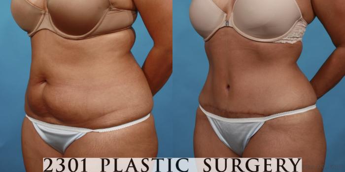 Before & After Tummy Tuck Case 500 View #2 View in Fort Worth, Plano, & Frisco, Texas