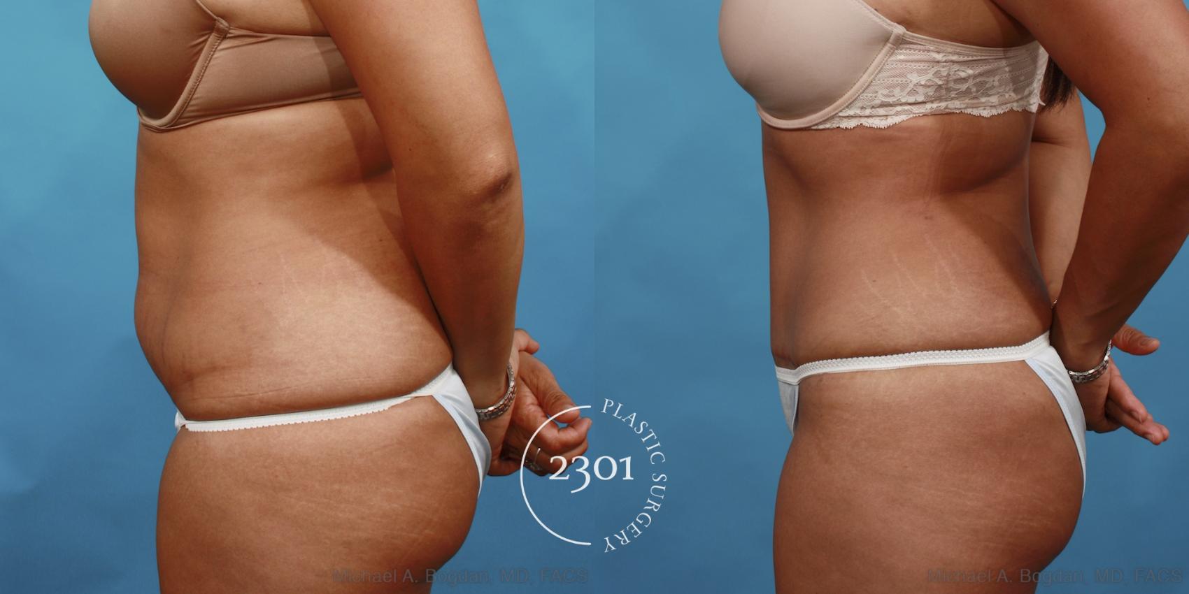 Before & After Tummy Tuck Case 500 View #3 View in Fort Worth, Plano, & Frisco, Texas