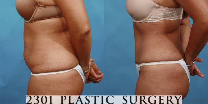 Before & After Tummy Tuck Case 500 View #3 View in Fort Worth, Plano, & Frisco, Texas