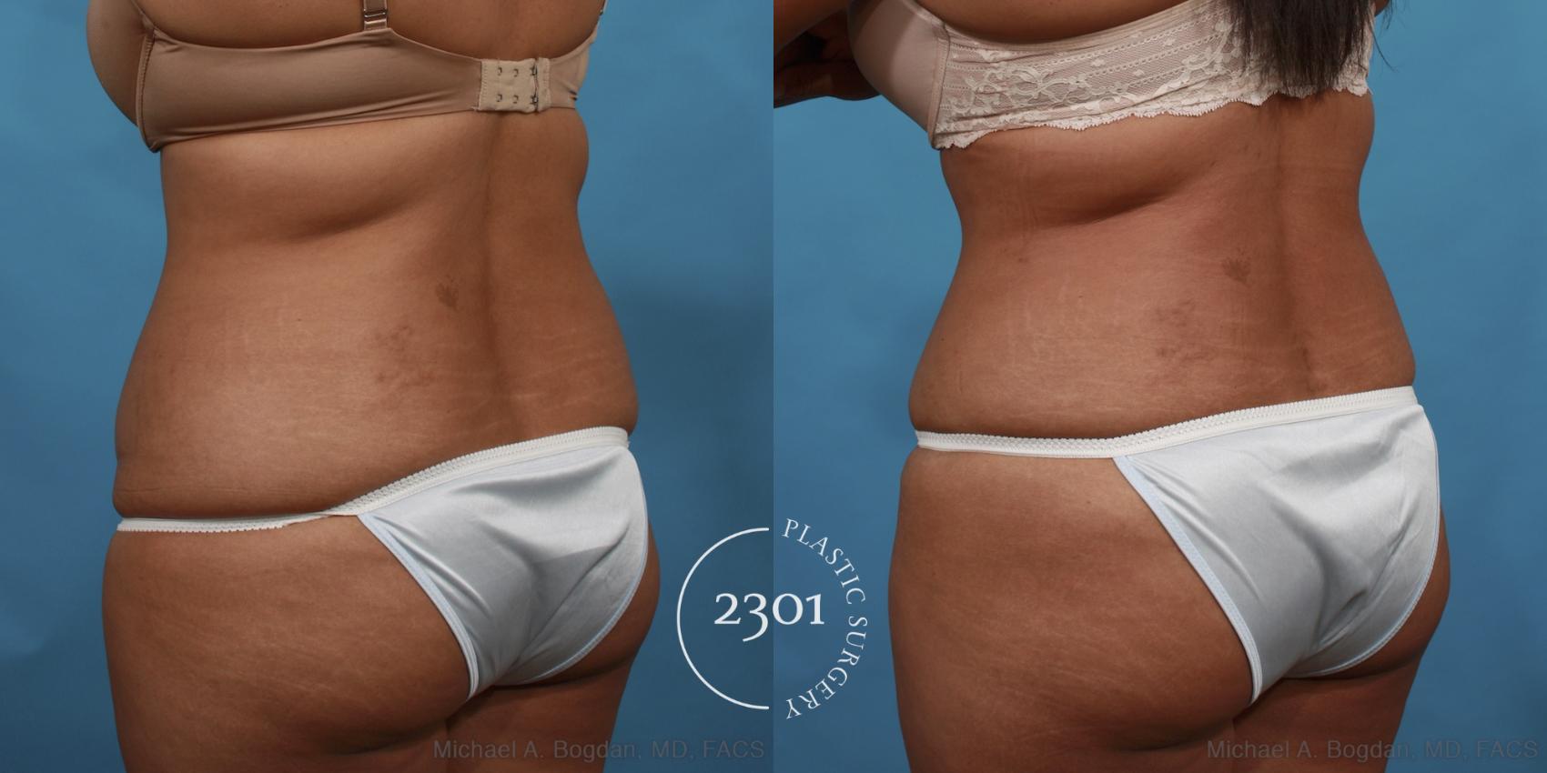 Before & After Tummy Tuck Case 500 View #4 View in Fort Worth, Plano, & Frisco, Texas