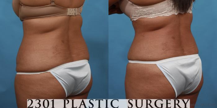 Before & After Tummy Tuck Case 500 View #4 View in Fort Worth, Plano, & Frisco, Texas