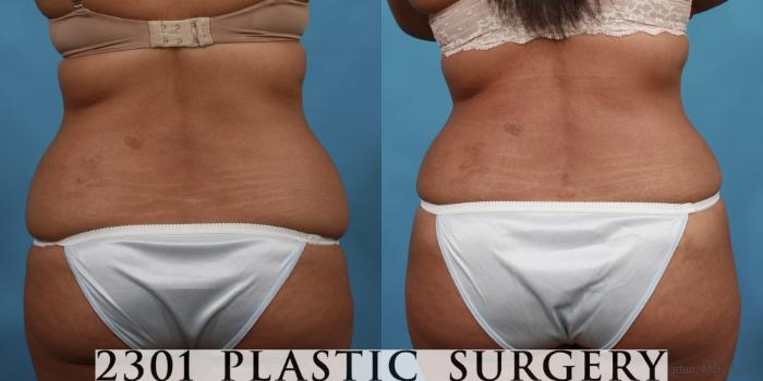 Before & After Tummy Tuck Case 500 View #5 View in Fort Worth, Plano, & Frisco, Texas