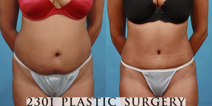 Before & After Tummy Tuck Case 508 View #1 View in Fort Worth, Plano, & Frisco, Texas