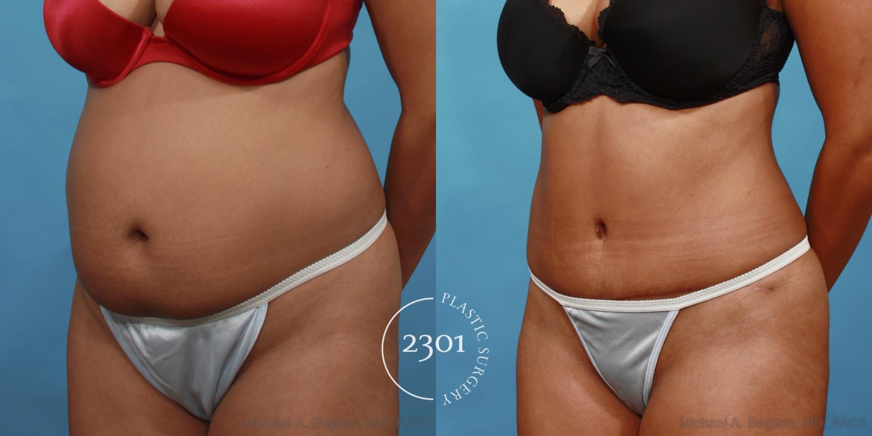 Before & After Tummy Tuck Case 508 View #2 View in Fort Worth, Plano, & Frisco, Texas