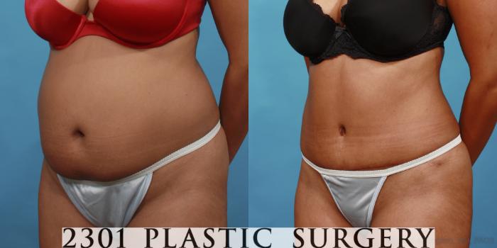Before & After Tummy Tuck Case 508 View #2 View in Fort Worth, Plano, & Frisco, Texas