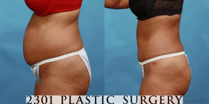 Before & After Tummy Tuck Case 508 View #3 View in Fort Worth, Plano, & Frisco, Texas