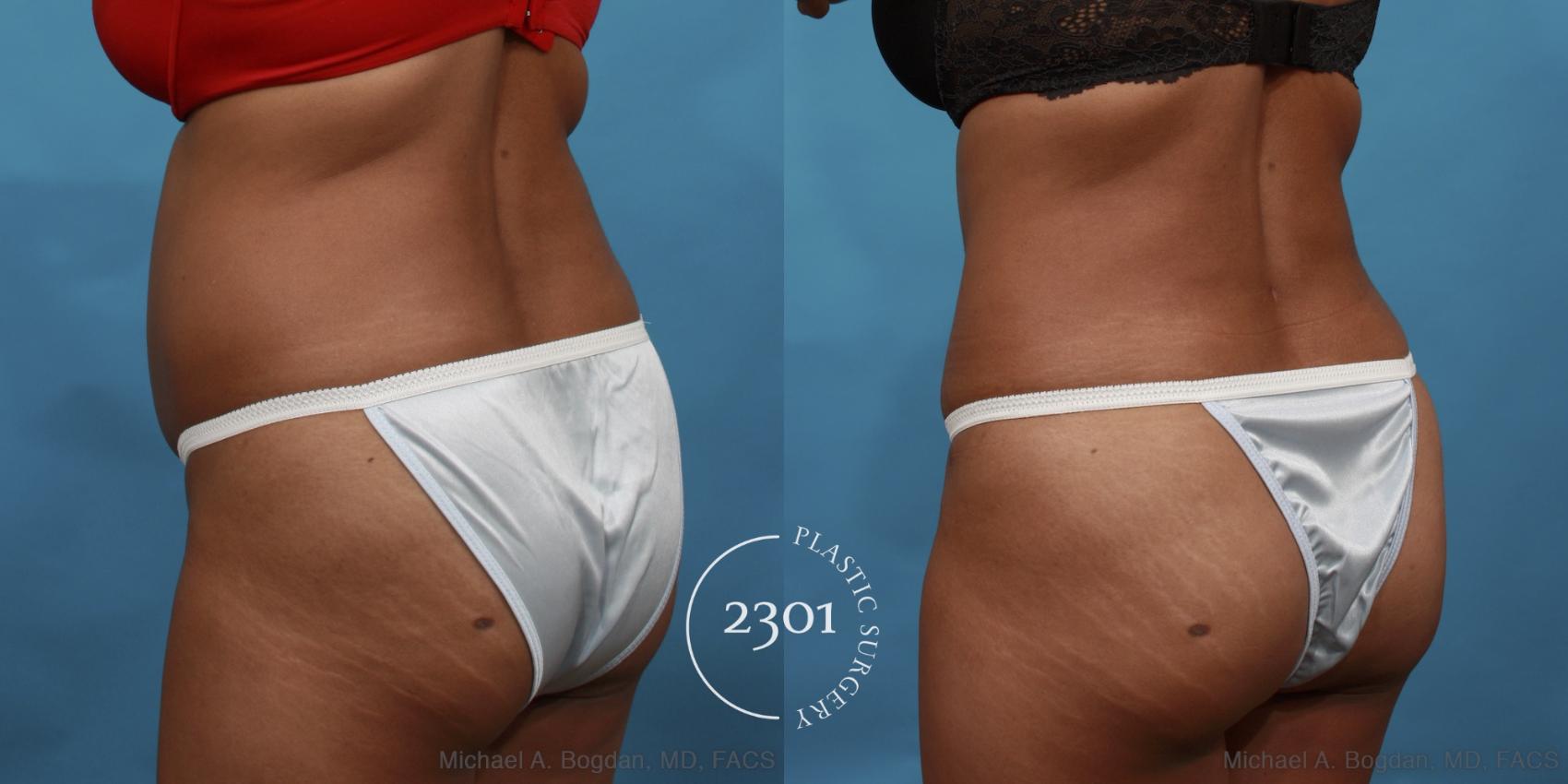Before & After Tummy Tuck Case 508 View #4 View in Fort Worth, Plano, & Frisco, Texas
