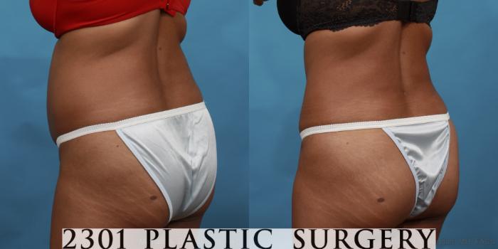 Before & After Tummy Tuck Case 508 View #4 View in Fort Worth, Plano, & Frisco, Texas